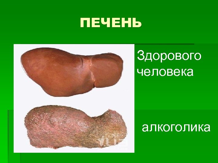 ПЕЧЕНЬ Здорового человека алкоголика 