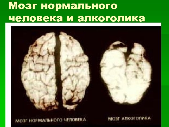 Мозг нормального человека и алкоголика 