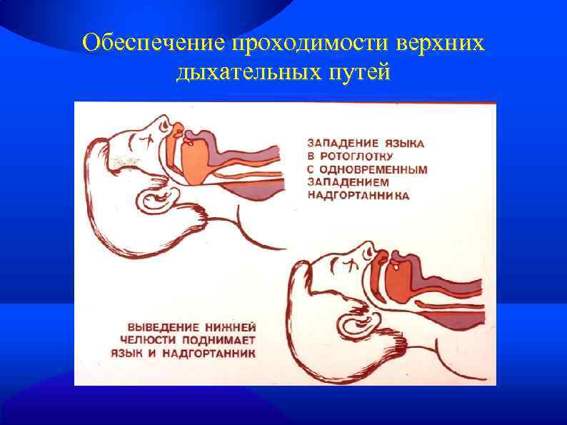 Обеспечение проходимости верхних дыхательных путей 