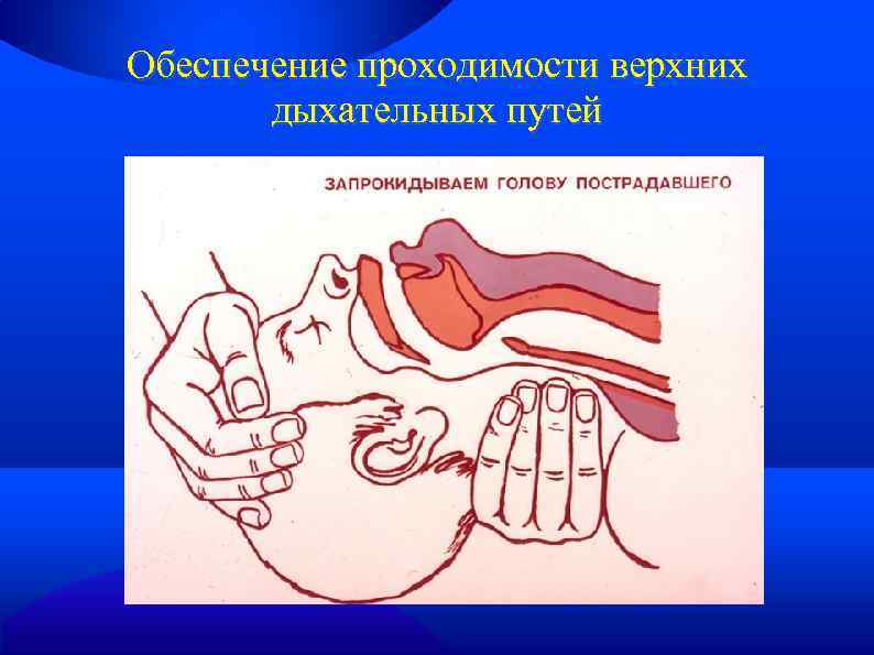 Обеспечение проходимости верхних дыхательных путей 