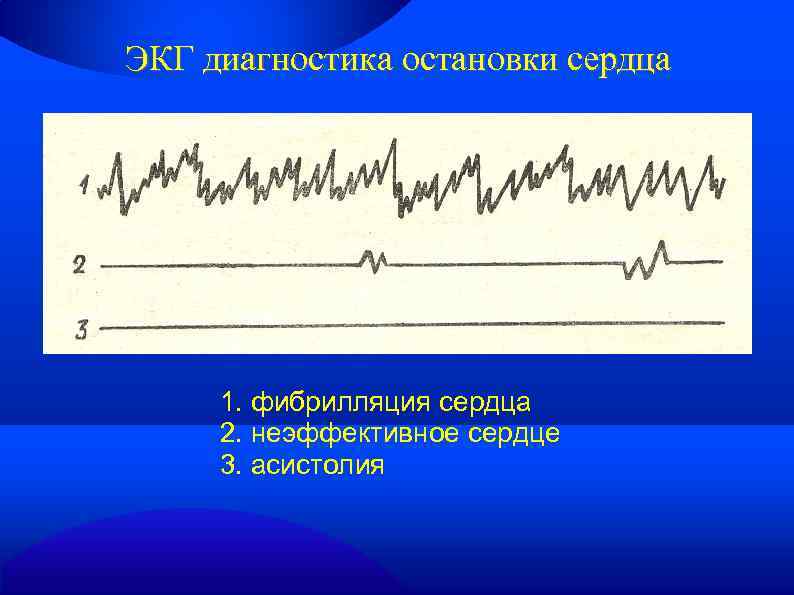 ЭКГ диагностика остановки сердца 1. фибрилляция сердца 2. неэффективное сердце 3. асистолия 