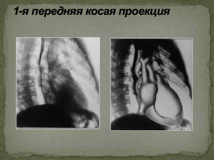 1 -я передняя косая проекция 