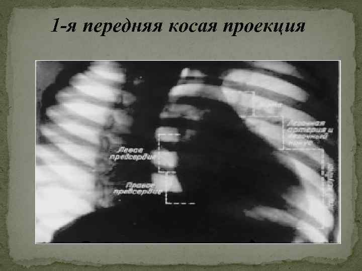 1 -я передняя косая проекция 