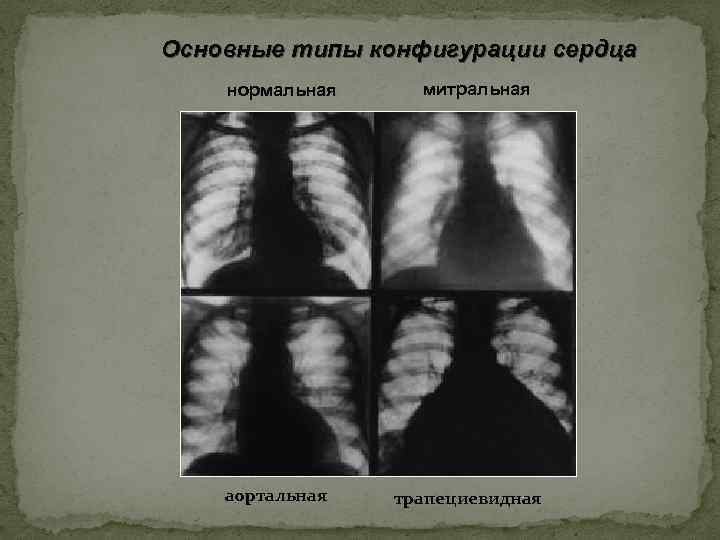 Основные типы конфигурации сердца нормальная аортальная митральная трапециевидная 