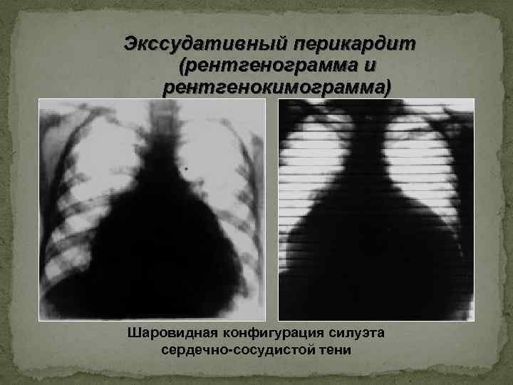 Экссудативный перикардит (рентгенограмма и рентгенокимограмма) Шаровидная конфигурация силуэта сердечно-сосудистой тени 