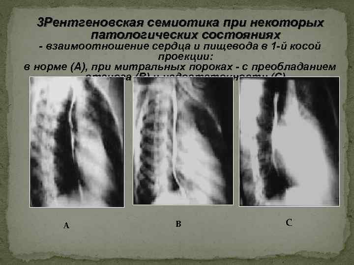 3 Рентгеновская семиотика при некоторых патологических состояниях - взаимоотношение сердца и пищевода в 1