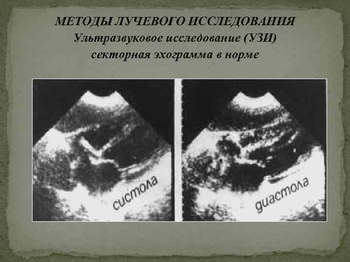 МЕТОДЫ ЛУЧЕВОГО ИССЛЕДОВАНИЯ Ультразвуковое исследование (УЗИ) секторная эхограмма в норме 