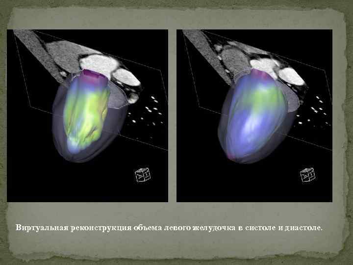  Виртуальная реконструкция объема левого желудочка в систоле и диастоле. 