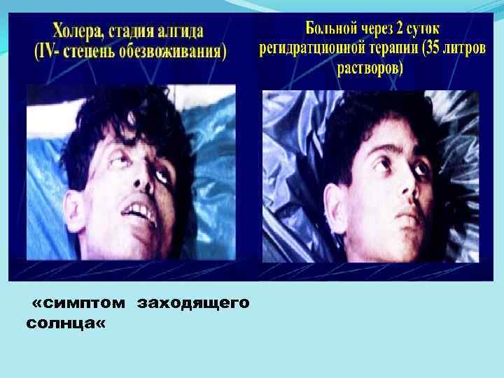  «симптом заходящего солнца « 