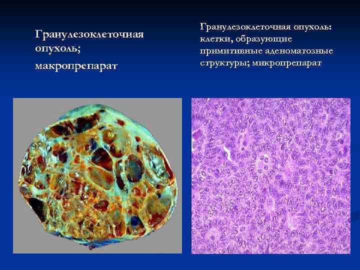 Гранулезоклеточная опухоль; макропрепарат Гранулезоклеточная опухоль: клетки, образующие примитивные аденоматозные структуры; микропрепарат 