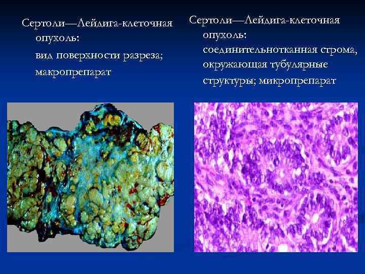 Сертоли—Лейдига-клеточная опухоль: вид поверхности разреза; макропрепарат Сертоли—Лейдига-клеточная опухоль: соединительнотканная строма, окружающая тубулярные структуры; микропрепарат