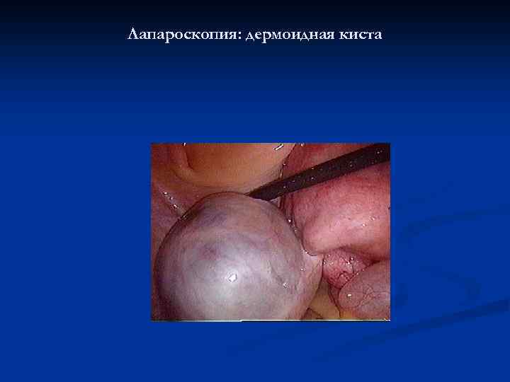 Лапароскопия: дермоидная киста 