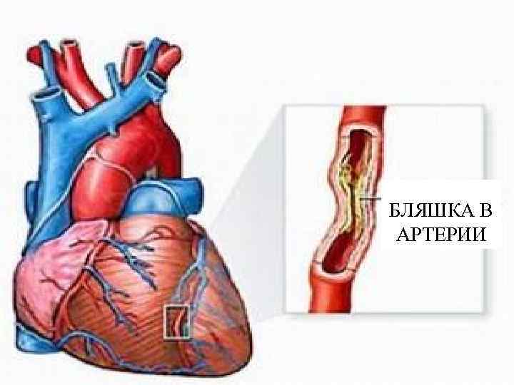 БЛЯШКА В АРТЕРИИ 