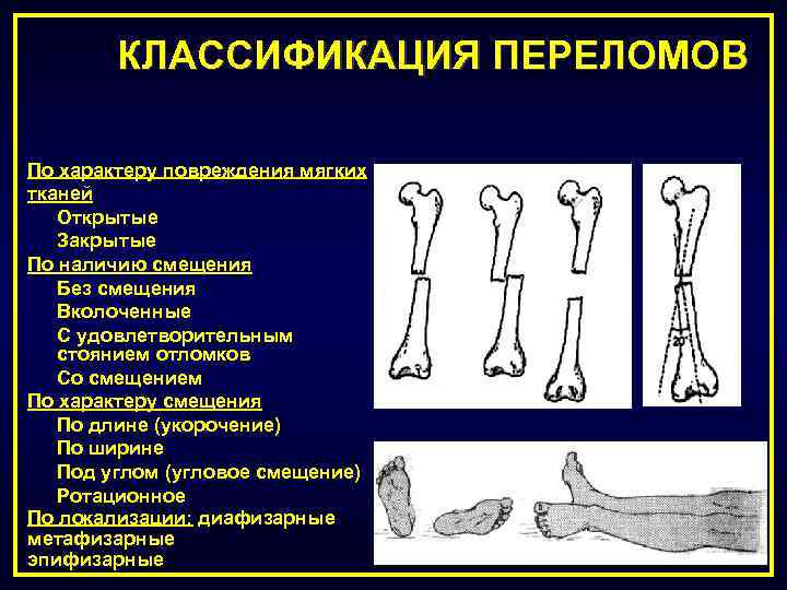 Перелом травма конечностей