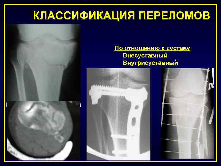 КЛАССИФИКАЦИЯ ПЕРЕЛОМОВ По отношению к суставу Внесуставный Внутрисуставный 
