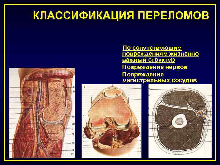 КЛАССИФИКАЦИЯ ПЕРЕЛОМОВ По сопутствующим повреждениям жизненно важный структур Повреждение нервов Повреждение магистральных сосудов 