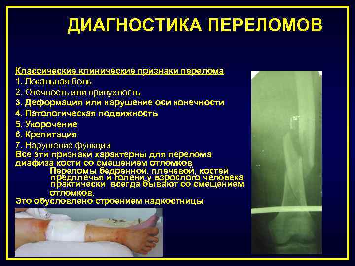 ДИАГНОСТИКА ПЕРЕЛОМОВ Классические клинические признаки перелома 1. Локальная боль 2. Отечность или припухлость 3.