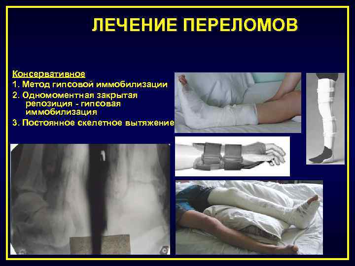 ЛЕЧЕНИЕ ПЕРЕЛОМОВ Консервативное 1. Метод гипсовой иммобилизации 2. Одномоментная закрытая репозиция - гипсовая иммобилизация