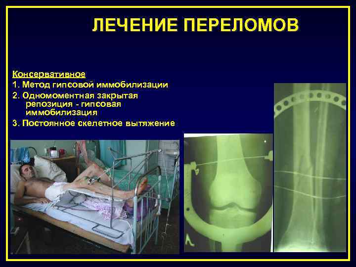 ЛЕЧЕНИЕ ПЕРЕЛОМОВ Консервативное 1. Метод гипсовой иммобилизации 2. Одномоментная закрытая репозиция - гипсовая иммобилизация