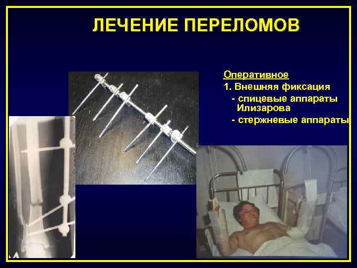 Оперативное лечение переломов презентация