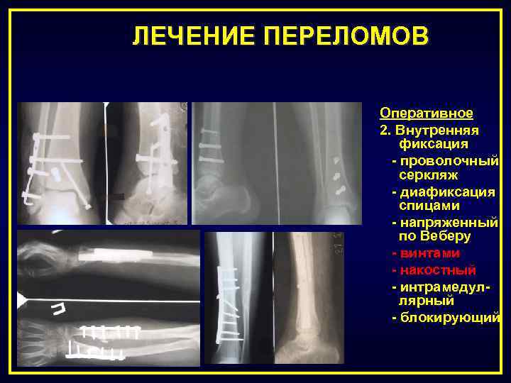 Оперативное лечение переломов презентация