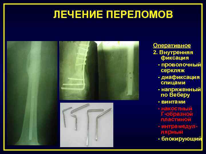 ЛЕЧЕНИЕ ПЕРЕЛОМОВ Оперативное 2. Внутренняя фиксация - проволочный серкляж - диафиксация спицами - напряженный