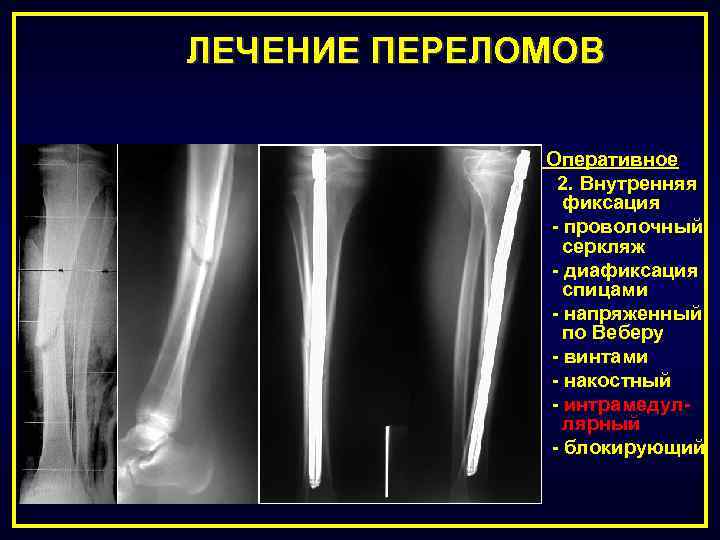 Оперативное лечение переломов презентация