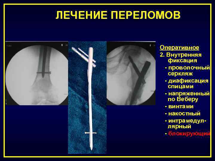 Оперативное лечение переломов презентация