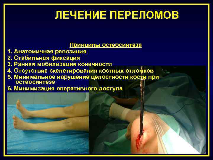 ЛЕЧЕНИЕ ПЕРЕЛОМОВ Принципы остеосинтеза 1. Анатомичная репозиция 2. Стабильная фиксация 3. Ранняя мобилизация конечности