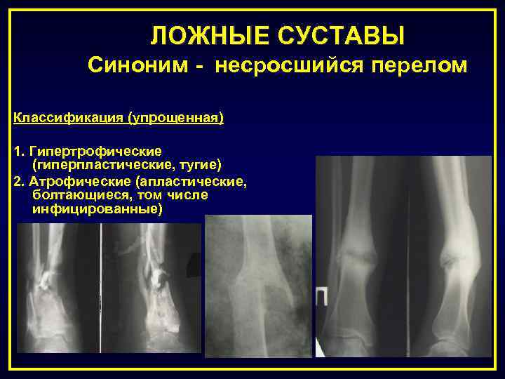 Почему не срастается кость