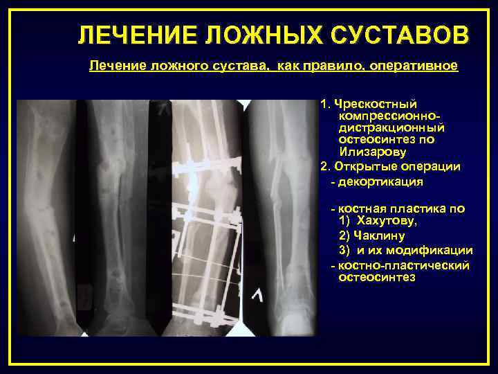 Ложный сустав. Нормотрофический ложный сустав. Ложный сустав большеберцовой кости. Причины формирования ложного сустава.