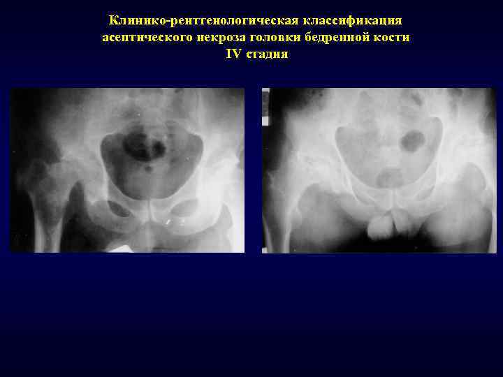 Клинико-рентгенологическая классификация асептического некроза головки бедренной кости IV стадия 