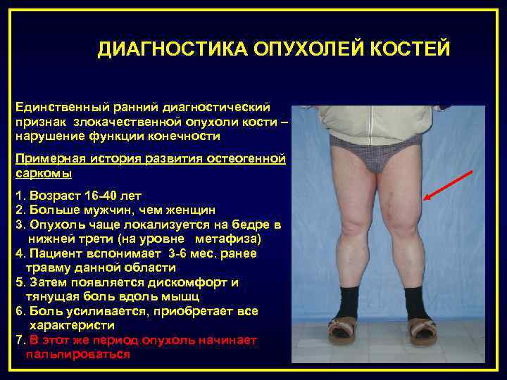 ДИАГНОСТИКА ОПУХОЛЕЙ КОСТЕЙ Единственный ранний диагностический признак злокачественной опухоли кости – нарушение функции конечности