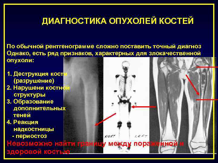 Разрушение кости болезнь