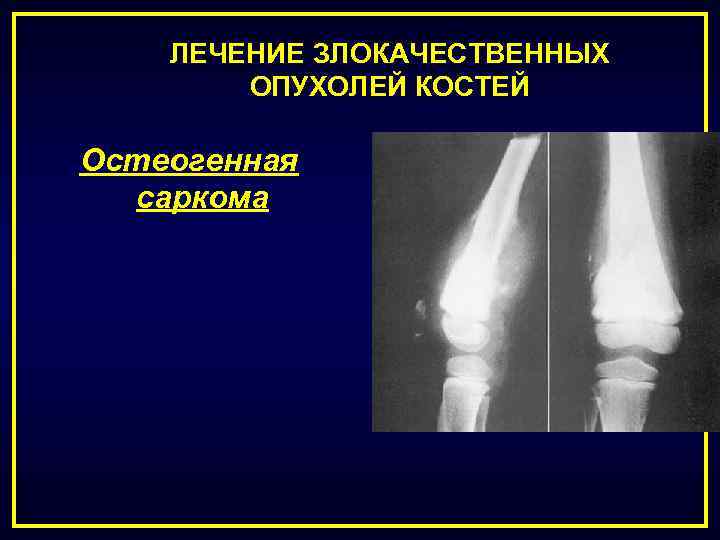 ЛЕЧЕНИЕ ЗЛОКАЧЕСТВЕННЫХ ОПУХОЛЕЙ КОСТЕЙ Остеогенная саркома 