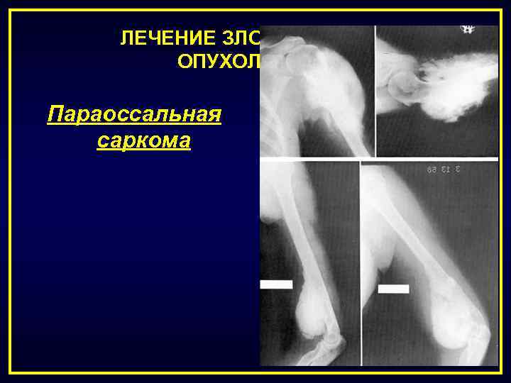 ЛЕЧЕНИЕ ЗЛОКАЧЕСТВЕННЫХ ОПУХОЛЕЙ КОСТЕЙ Параоссальная саркома 