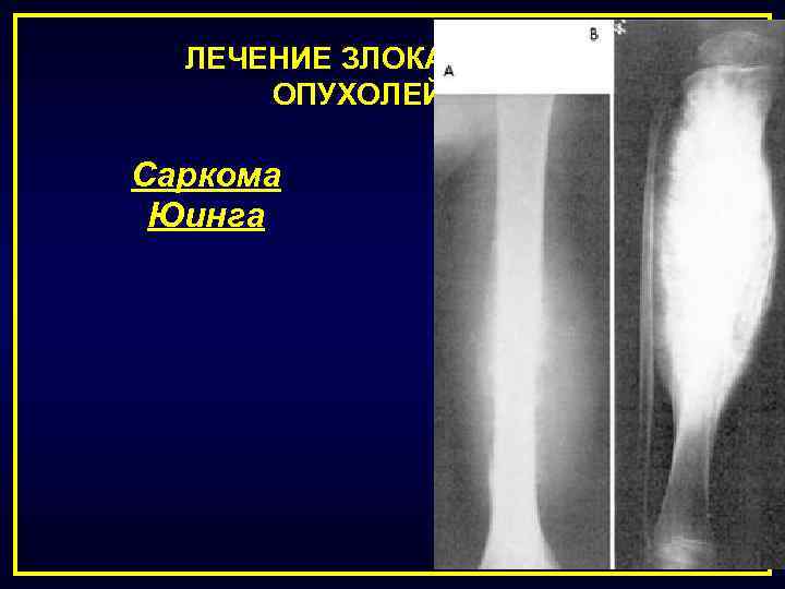 ЛЕЧЕНИЕ ЗЛОКАЧЕСТВЕННЫХ ОПУХОЛЕЙ КОСТЕЙ Саркома Юинга 