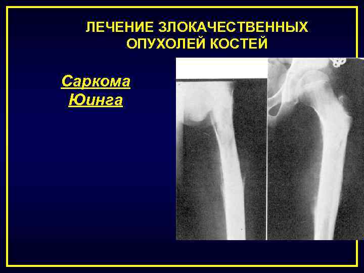 ЛЕЧЕНИЕ ЗЛОКАЧЕСТВЕННЫХ ОПУХОЛЕЙ КОСТЕЙ Саркома Юинга 