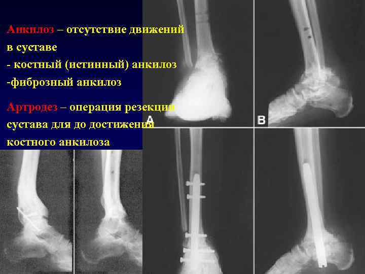 Анкилоз это. Фиброзный анкилоз голеностопного сустава. Костный анкилоз коленного сустава. Костный анкилоз на рентгене.