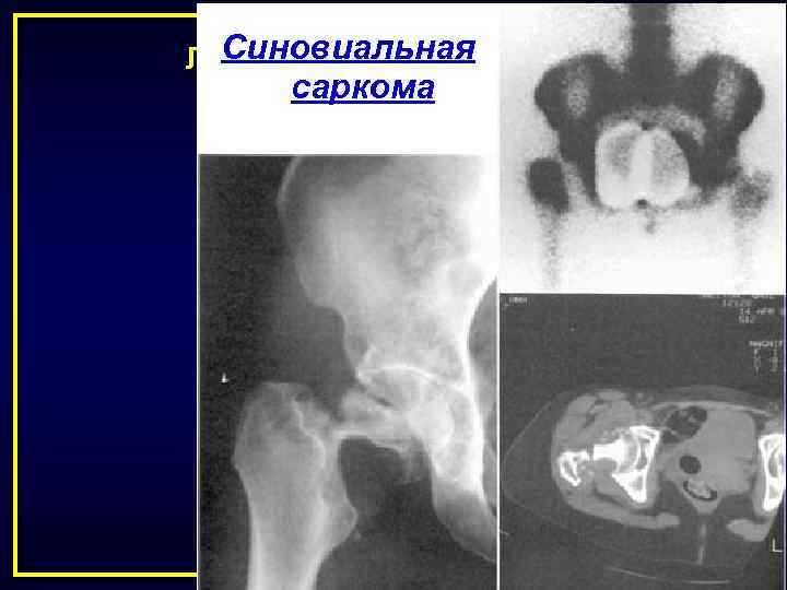 Синовиальная ЛЕЧЕНИЕ ЗЛОКАЧЕСТВЕННЫХ саркома ОПУХОЛЕЙ КОСТЕЙ 