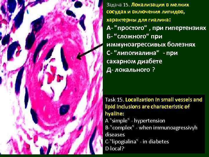 Задача 15. Локализация в мелких сосудах и включения липидов, характерны для гиалина: А- 