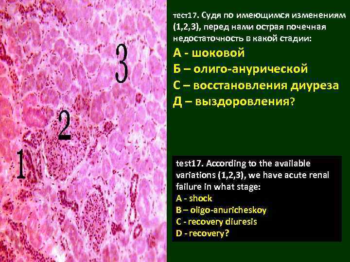 тест17. Судя по имеющимся изменениям (1, 2, 3), перед нами острая почечная недостаточность в