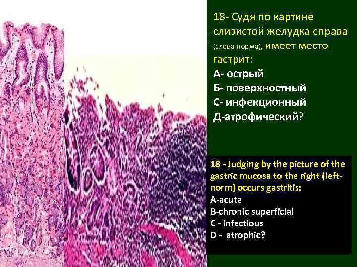 18 - Судя по картине слизистой желудка справа (слева-норма), имеет место гастрит: А- острый