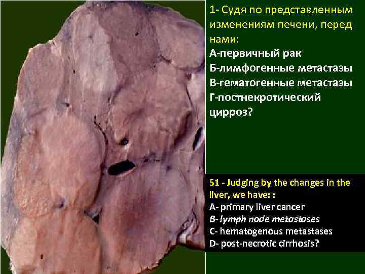 1 - Судя по представленным изменениям печени, перед нами: А-первичный рак Б-лимфогенные метастазы В-гематогенные