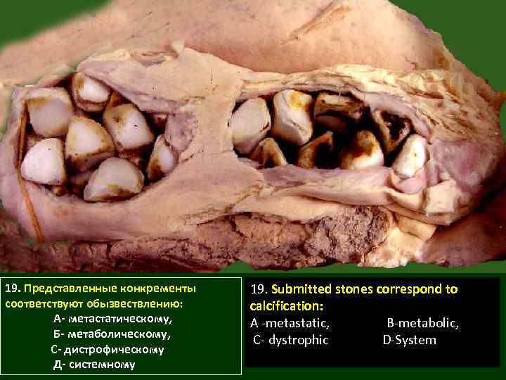 19. Представленные конкременты соответствуют обызвествлению: А- метастатическому, Б- метаболическому, С- дистрофическому Д- системному 19.