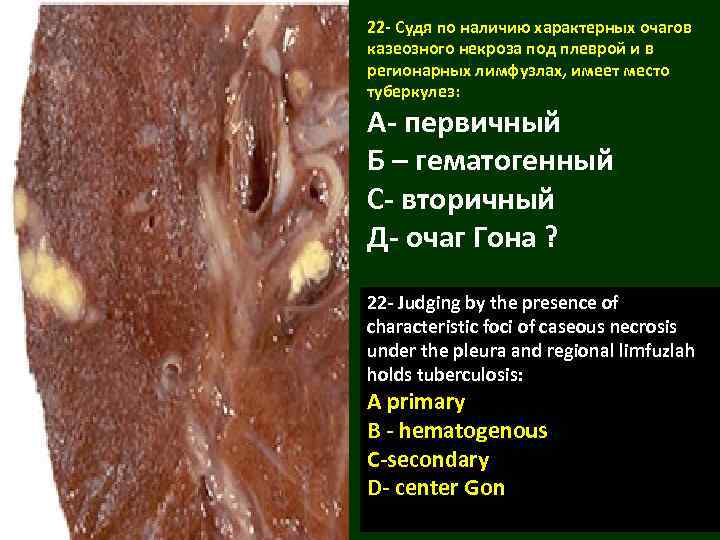 22 - Судя по наличию характерных очагов казеозного некроза под плеврой и в регионарных