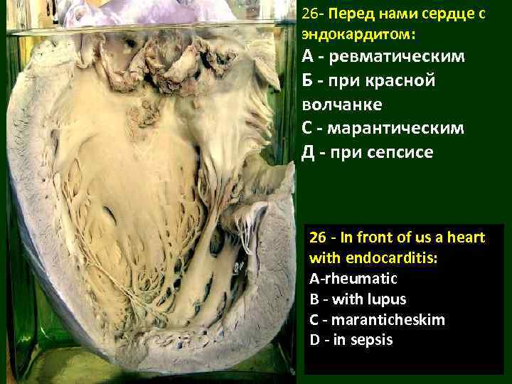 26 - Перед нами сердце с эндокардитом: А - ревматическим Б - при красной