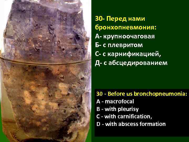 30 - Перед нами бронхопневмония: А- крупноочаговая Б- с плевритом С- с карнификацией, Д-