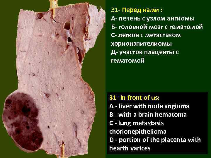 31 - Перед нами : А- печень с узлом ангиомы Б- головной мозг с