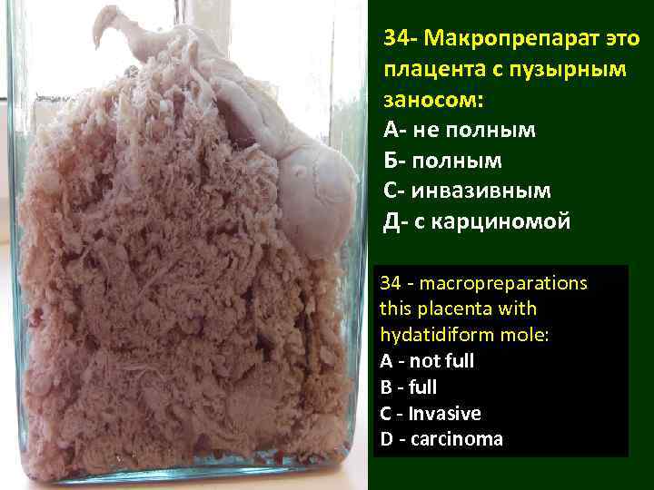 34 - Макропрепарат это плацента с пузырным заносом: А- не полным Б- полным С-